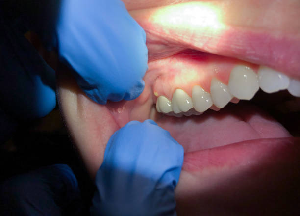 Best Emergency Dental Extractions in West Jefferson, OH